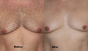 laser-hair-removal-before-and-after
