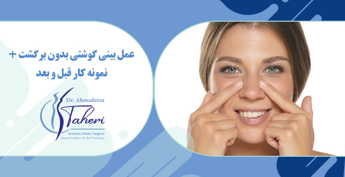 عمل بینی گوشتی بدون برگشت + نمونه کار قبل و بعد
