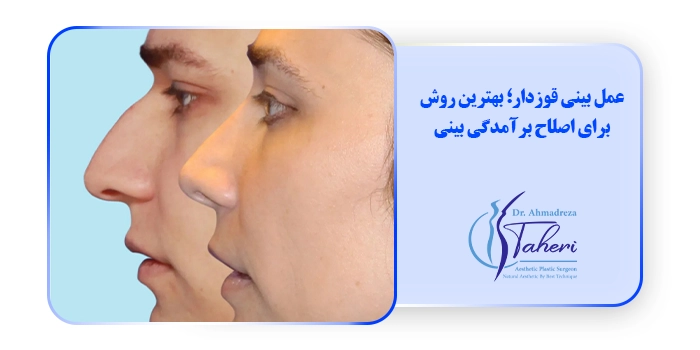 عمل بینی قوزدار؛ بهترین روش برای اصلاح برآمدگی بینی