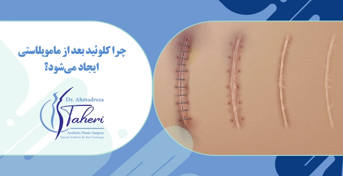 چرا کلوئید بعد از ماموپلاستی ایجاد می‌شود؟