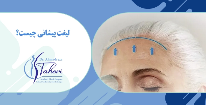 روش‌های لیفت پیشانی با جراحی و بدون جراحی
