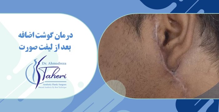 درمان گوشت اضافه بعد از لیفت صورت
