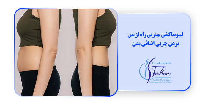 لیپوساکشن بهترین راه برای از بین بردن چربی اضافی بدن