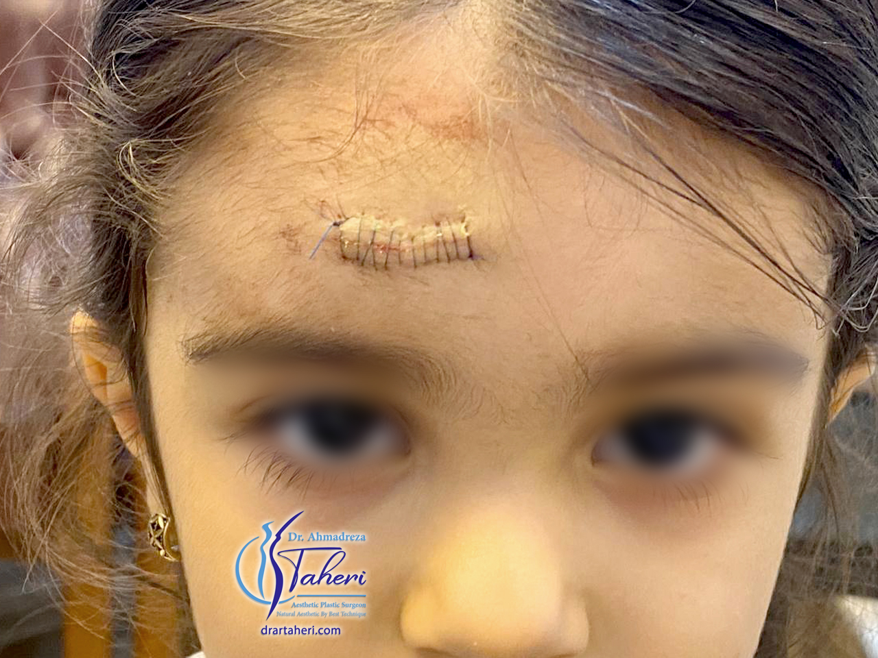قبل — جراحة Keloid