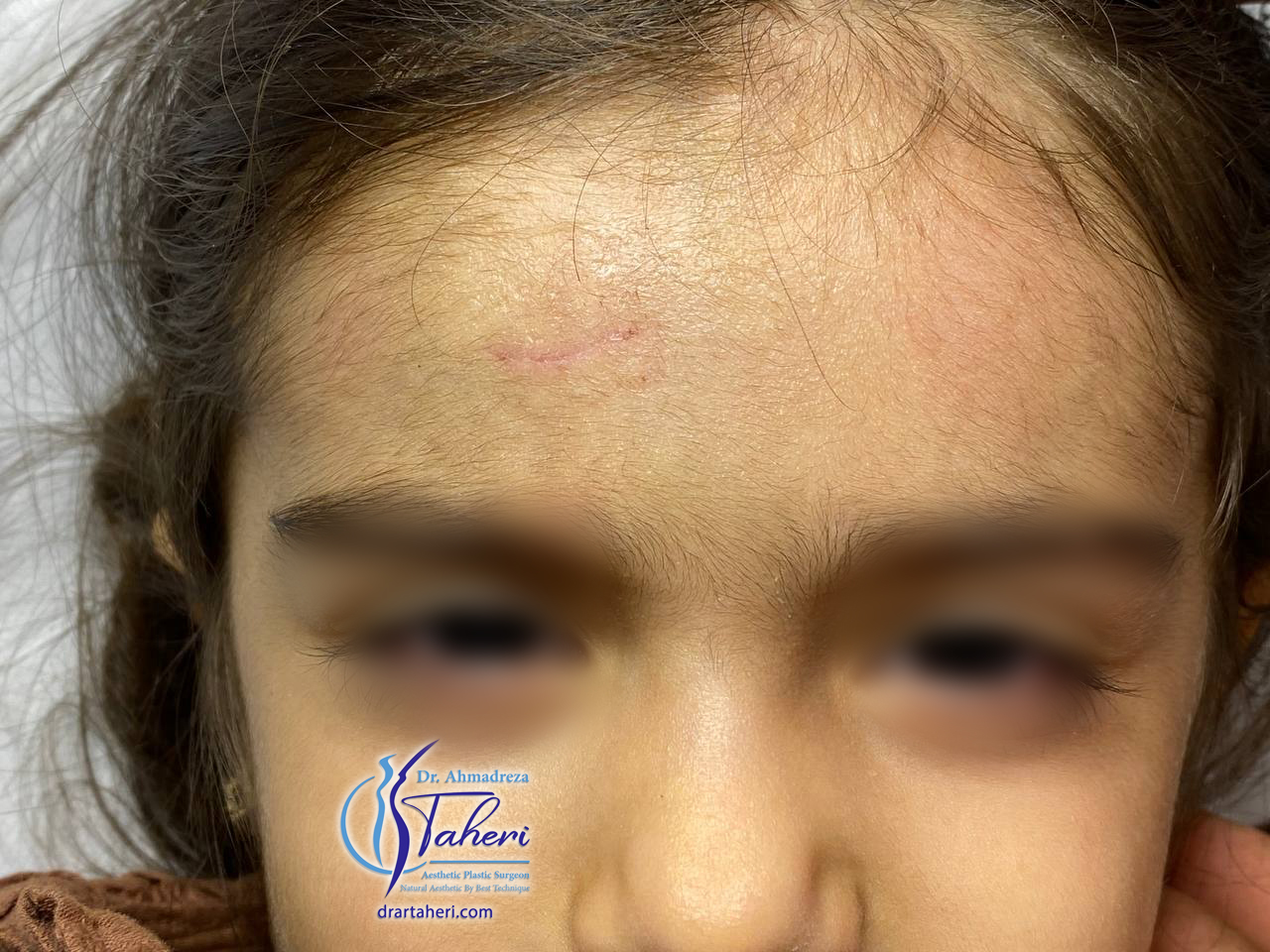 بعد — جراحة Keloid