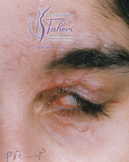 قبل — جراحة الجفن (Blepharoplasty)