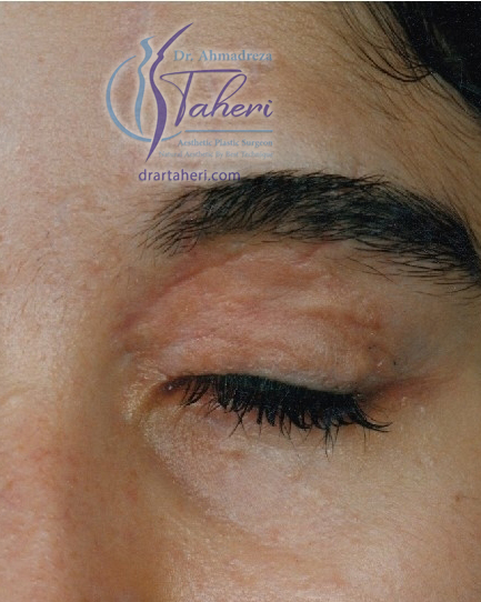 بعد — جراحة الجفن (Blepharoplasty)