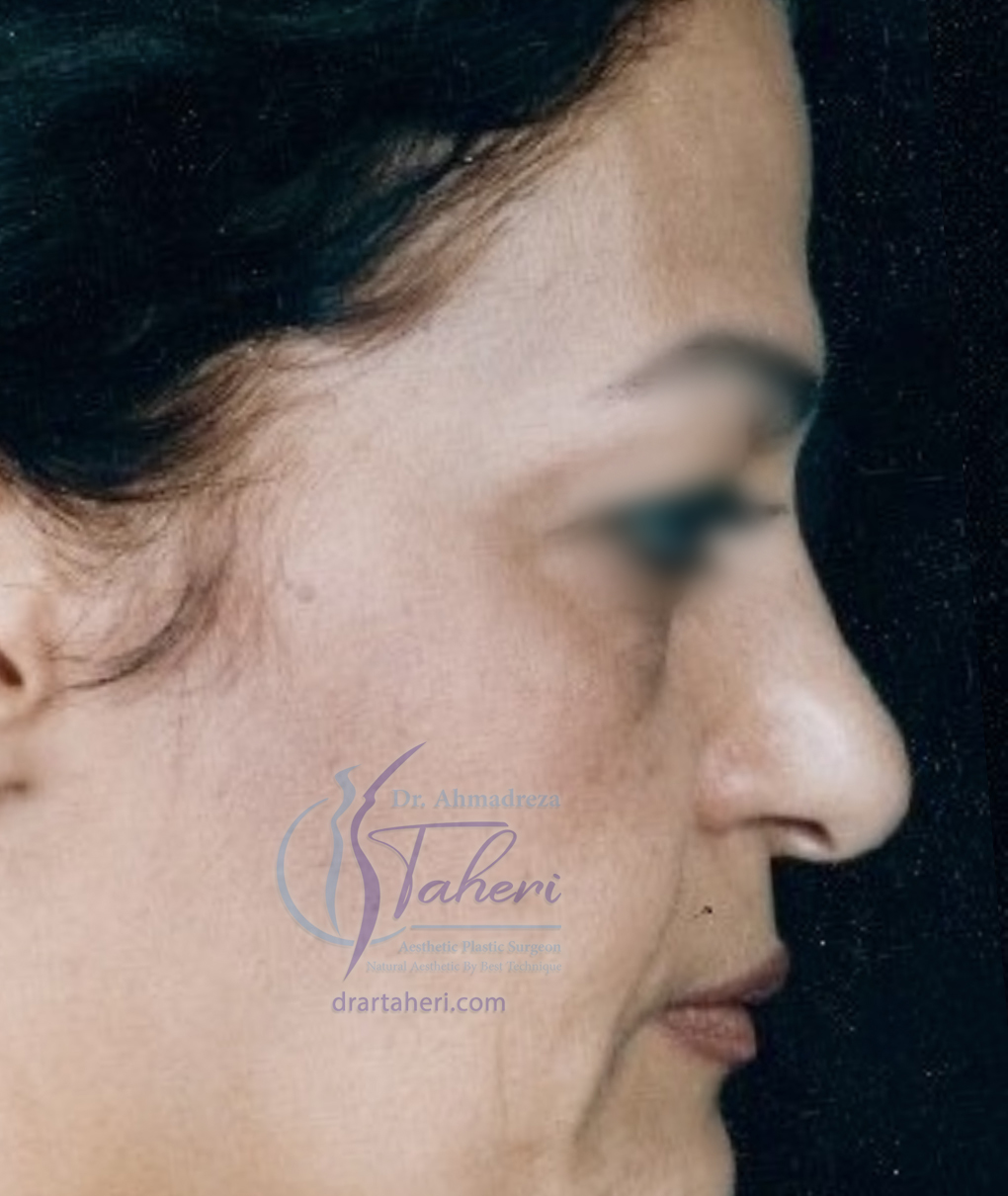 قبل — جراحة الجفن (Blepharoplasty)