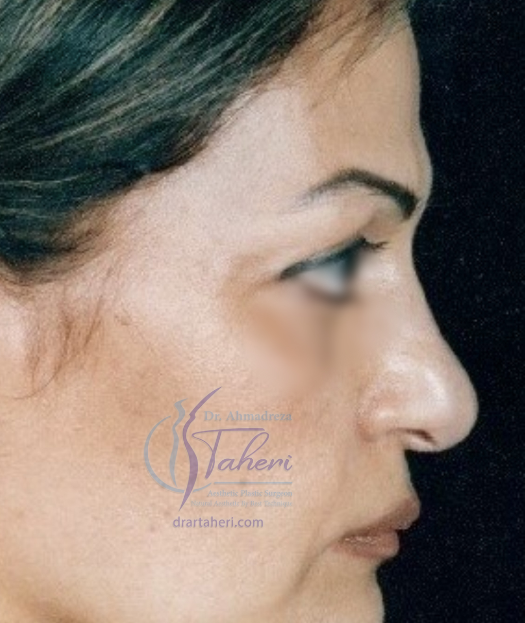بعد — جراحة الجفن (Blepharoplasty)