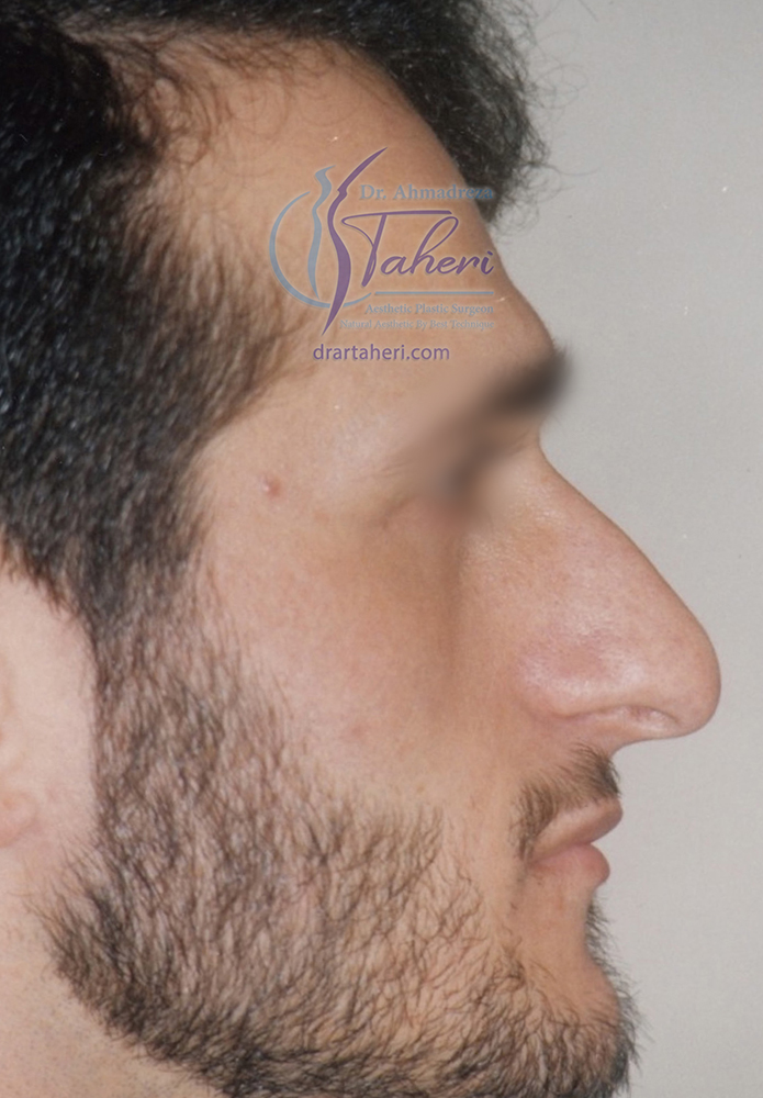 قبل — رینوپلاستی (جراحة الأنف)
