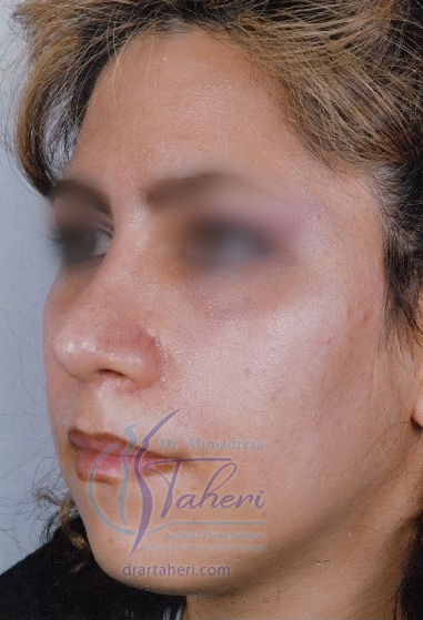 بعد — رینوپلاستی (جراحة الأنف)