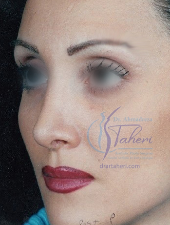 بعد — رینوپلاستی (جراحة الأنف)