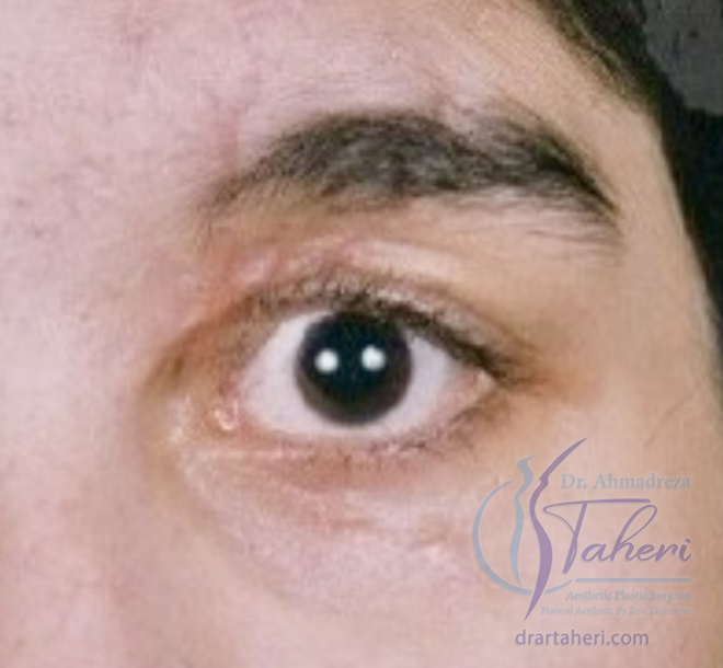 قبل — جراحة الجفن (Blepharoplasty)