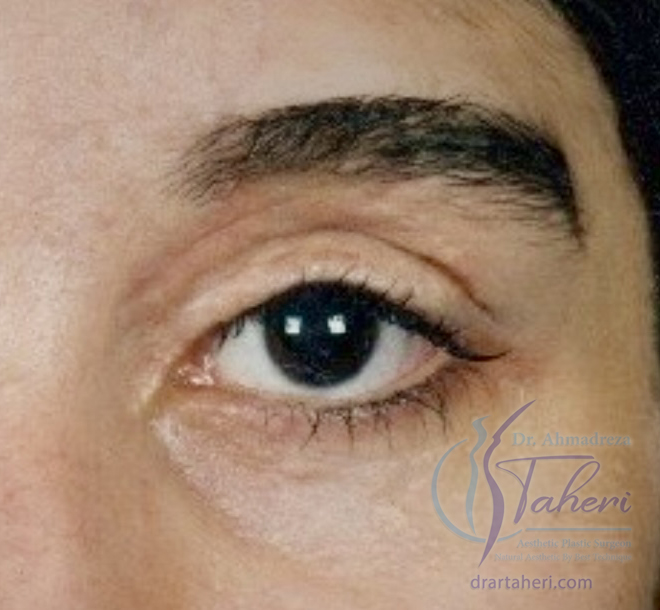 بعد — جراحة الجفن (Blepharoplasty)