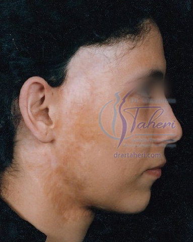 قبل — جراحات تجميلية أخرى