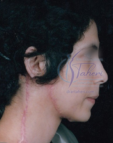 بعد — جراحات تجميلية أخرى