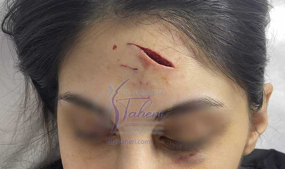 قبل — جراحات تجميلية أخرى