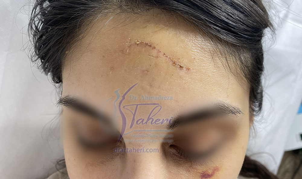 بعد — جراحات تجميلية أخرى