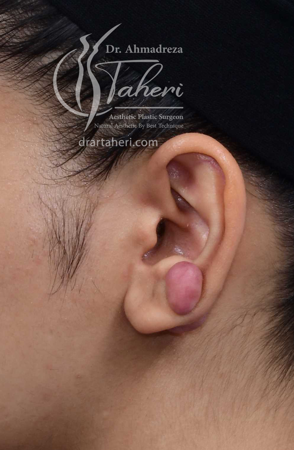 قبل — جراحة Keloid