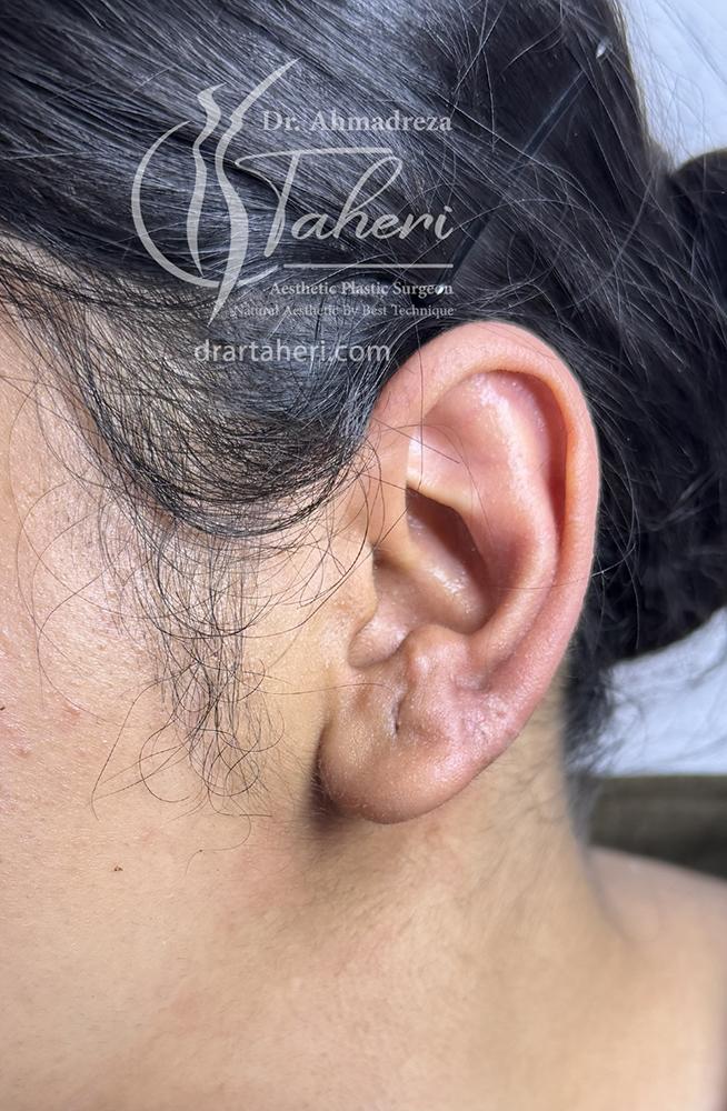 بعد — جراحة Keloid