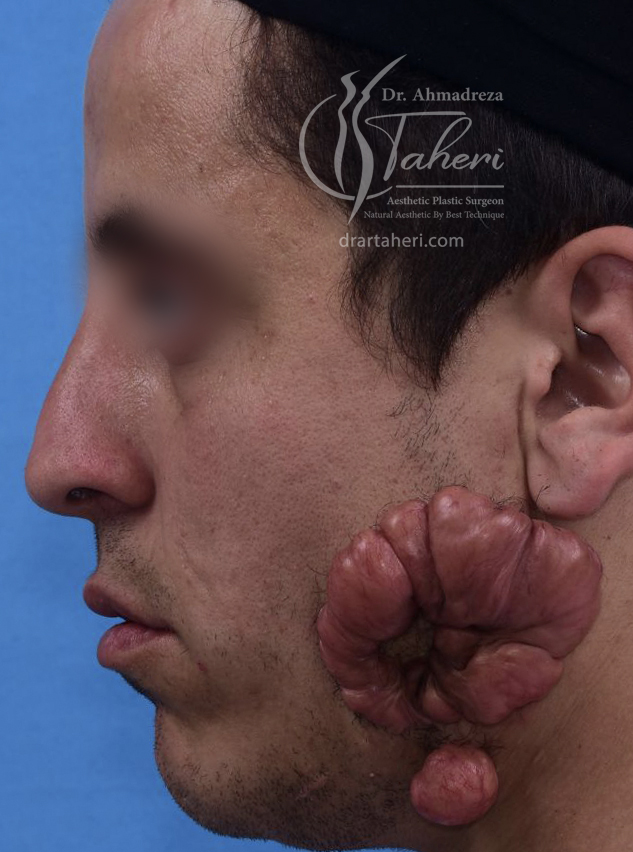 قبل — جراحة Keloid