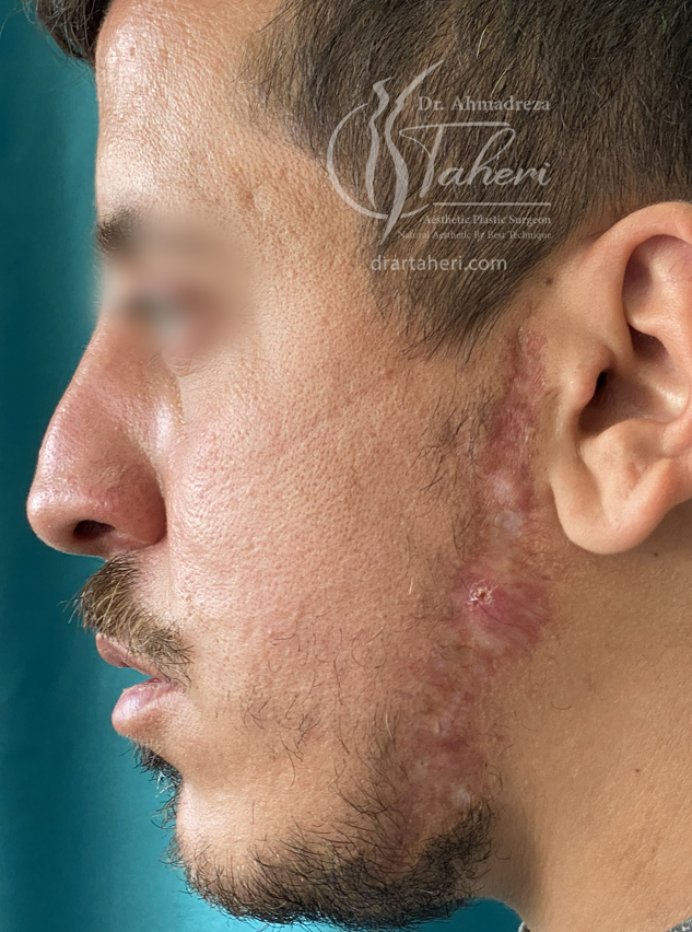 بعد — جراحة Keloid