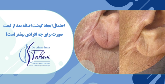 احتمال ایجاد گوشت اضافه بعد از لیفت صورت برای چه افرادی بیشتر است؟