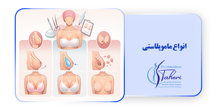 انواع ماموپلاستی