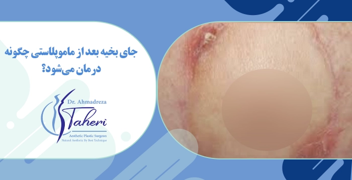 جای بخیه بعد از ماموپلاستی چگونه درمان می‌شود؟
