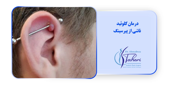 درمان کلوئید ناشی از پیرسینگ
