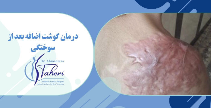 درمان گوشت اضافه بعد از سوختگی
