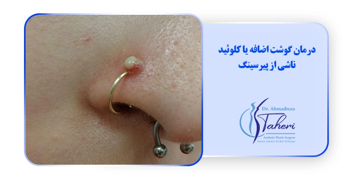 درمان گوشت اضافه یا کلوئید ناشی از پیرسینگ