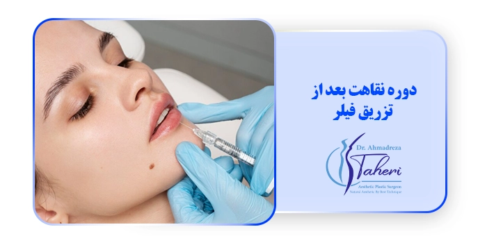 دوره نقاهت بعد از تزریق فیلر