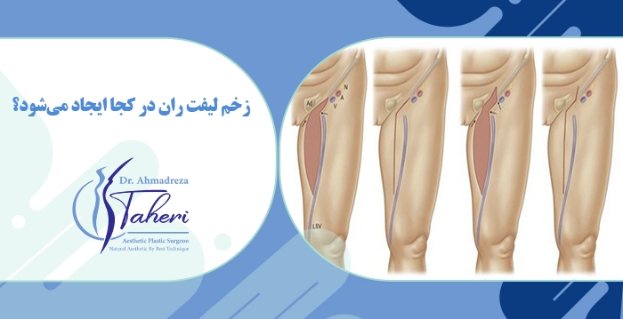 زخم لیفت ران در کجا ایجاد می‌شود؟ 