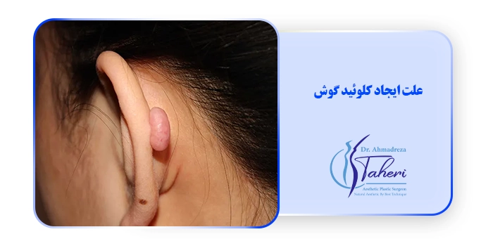 علت ایجاد کلوئید گوش