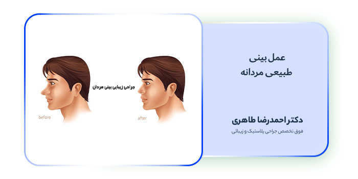 عمل بینی طبیعی مردانه