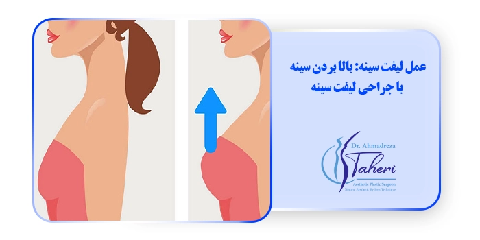 عمل لیفت سینه: بالا بردن سینه با جراحی لیفت سینه