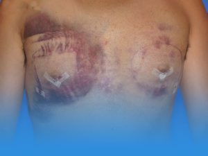 عوارض عمل ژنیکوماستی