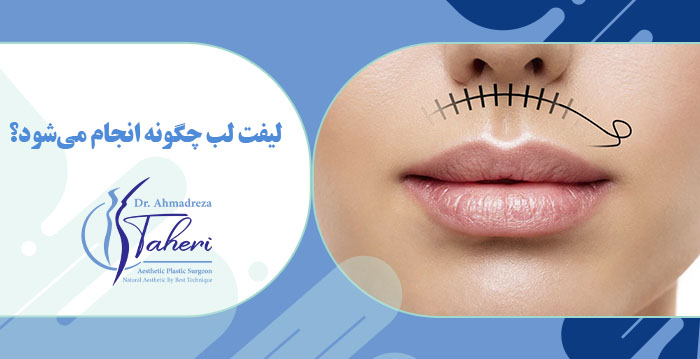 لیفت لب چگونه انجام می‌شود؟