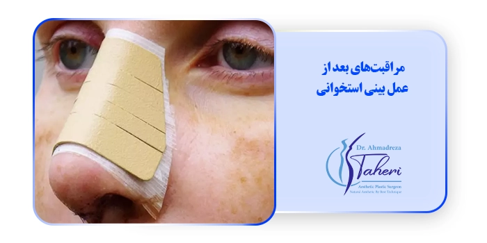 مراقبت‌های بعد از عمل بینی استخوانی