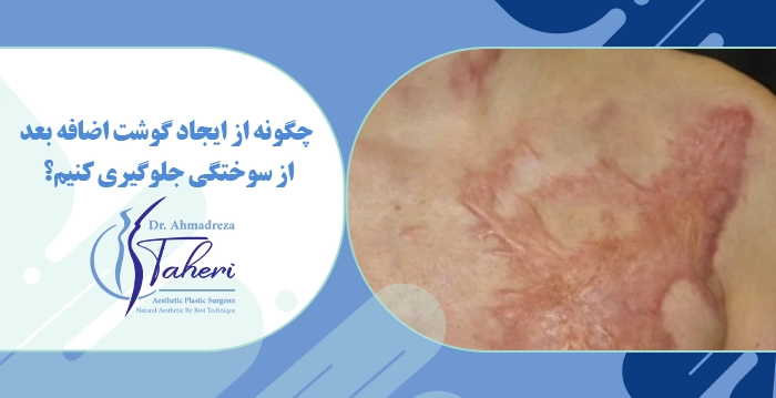  چگونه از ایجاد گوشت اضافه بعد از سوختگی جلوگیری کنیم؟