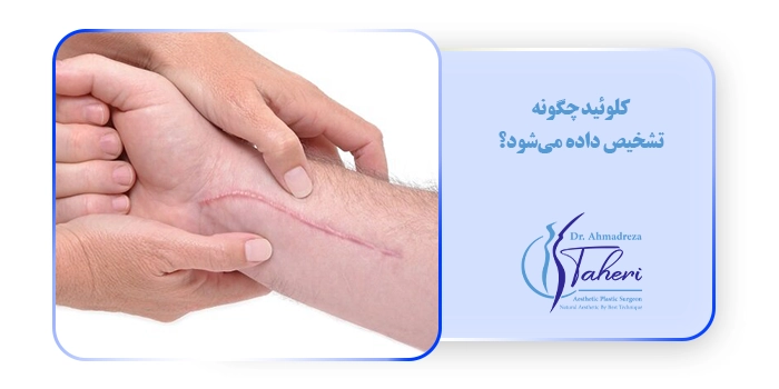 کلوئید چگونه تشخیص داده می‌شود؟