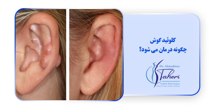کلوئید گوش چگونه درمان می شود؟